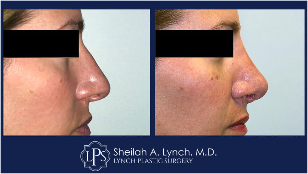 Rhinoplasty patient 9 Nose Reshaping Before After Chevy Chase Maryland Plastic Surgeon Easton Maryland