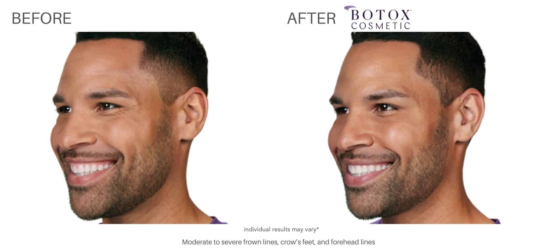 BOTOX FOR MEN SPECIALS CHEVY CHASE Bridey Shastany, RN, LME, Lynch Plastic Surgery