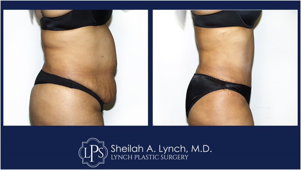 Tummy Tuck Before and After Easton Maryland