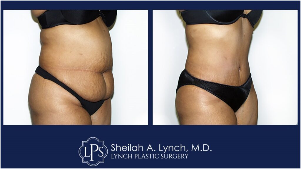 Tummy Tuck Before and After Easton Maryland