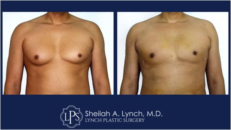 Patient 1 Male Breast Reduction, Male Breast Lift, Excess Breast Skin Removal