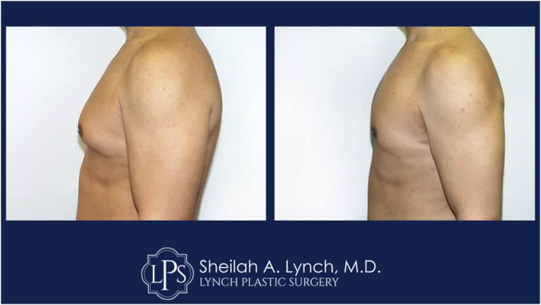 Patient 1 Male Breast Reshaping