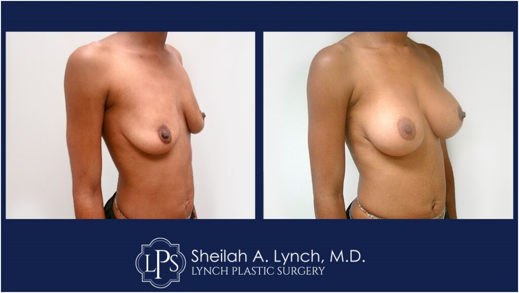 Before and After Breast Augmentation Images with Easton Maryland