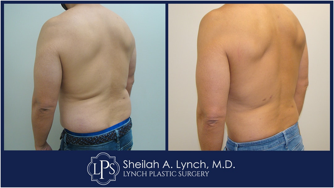 Maryland's Best Lipo 360 / Liposuction Results!