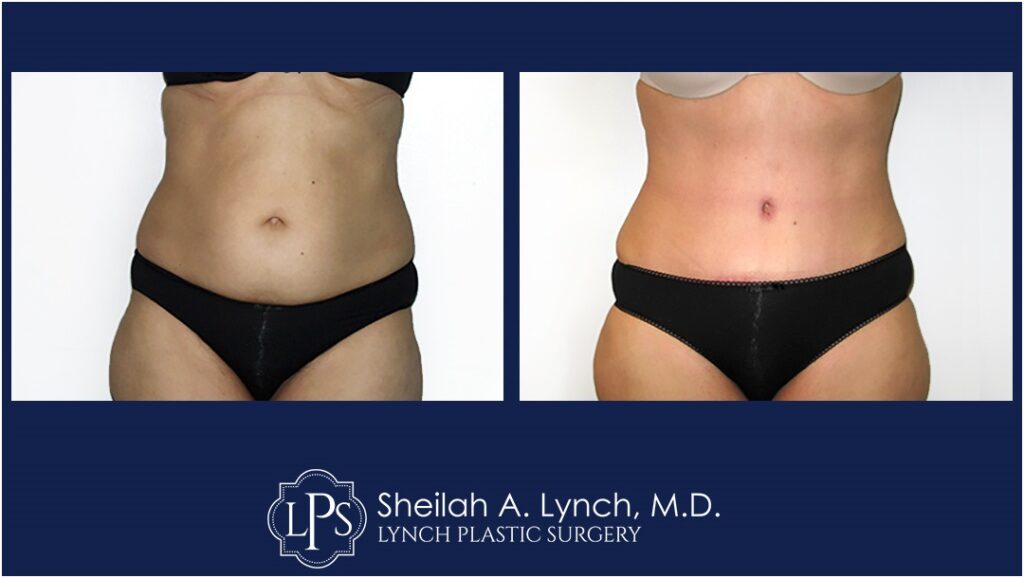 Lipo 360 / Liposuction before and after images - LIPO 360 Maryland