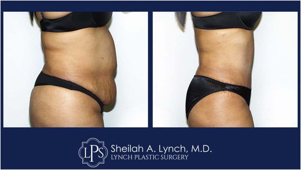 Lipo 360 Before and After Pictures, Liposuction Easton Maryland