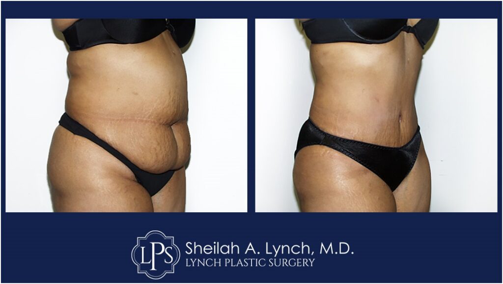 Lipo 360 Before and After Pictures, Liposuction Easton Maryland