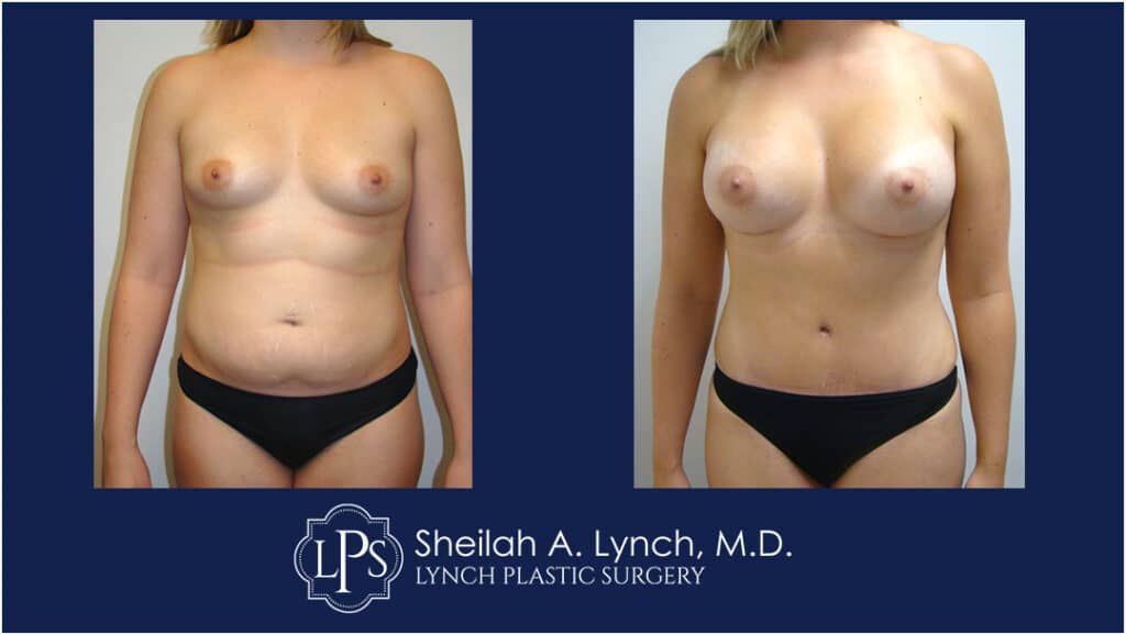 Before and After Breast Augmentation Images with Lipo 360 Tummy Tuck Easton Maryland