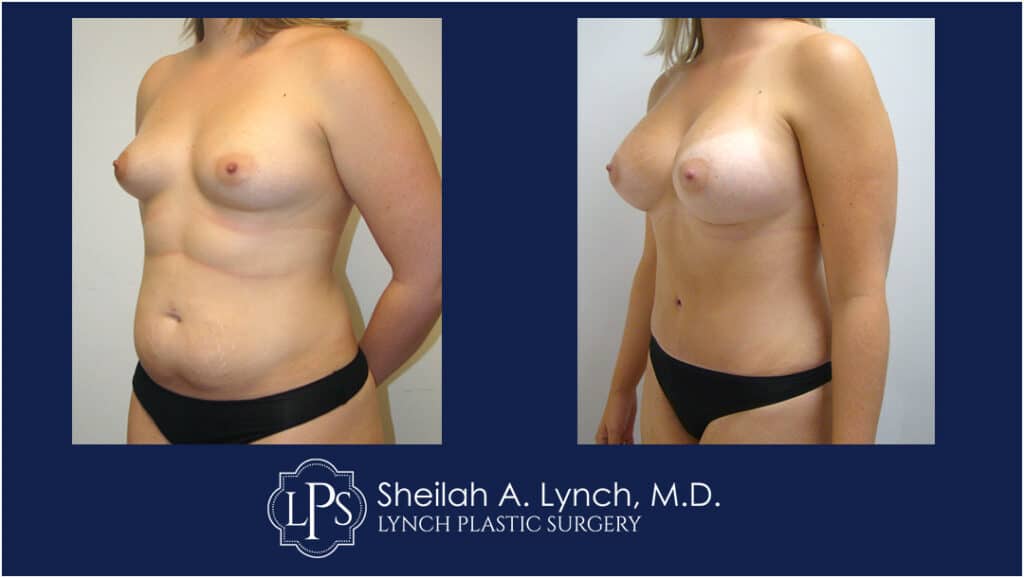 Before and After Breast Augmentation Images Chevy Chase, Maryland. Images with Lipo 360 Tummy Tuck.