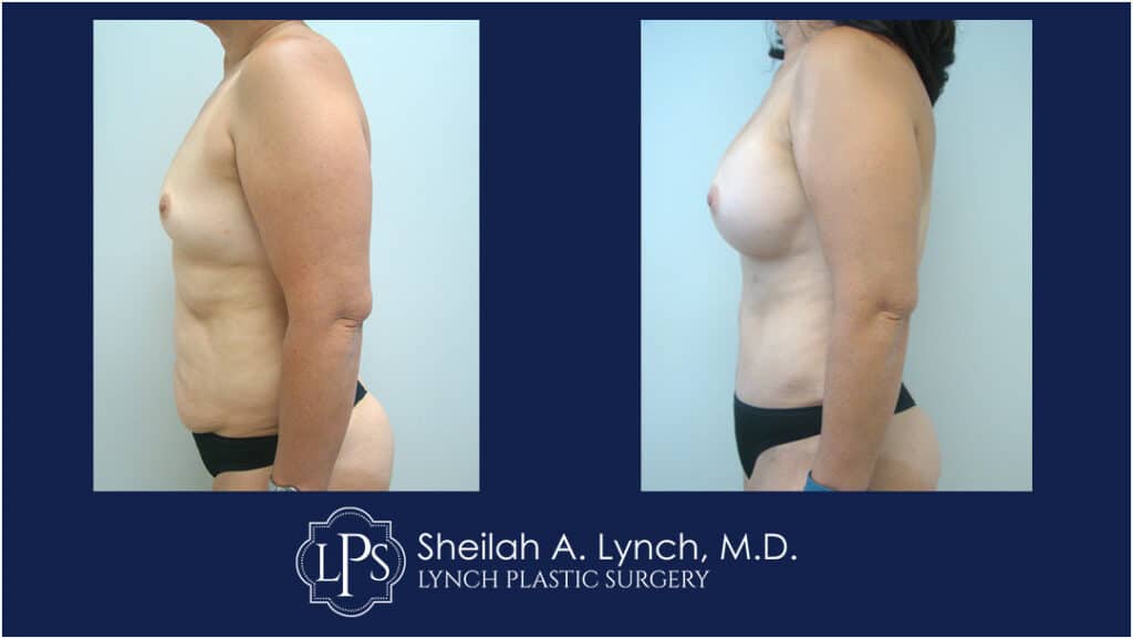 Mommy Makeover Before and After Patient Photo - Easton Maryland