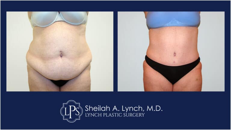 Tummy Tuck - Lipo 360 Before and After Maryland
