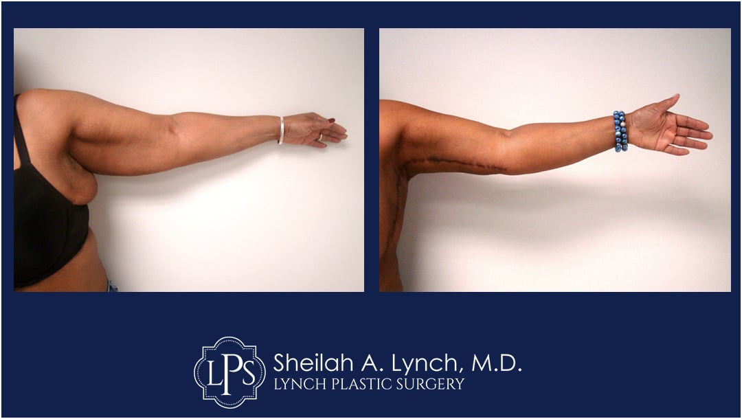 Before After Patient 3 Extended Brachioplasty Arm Lift / Lipo