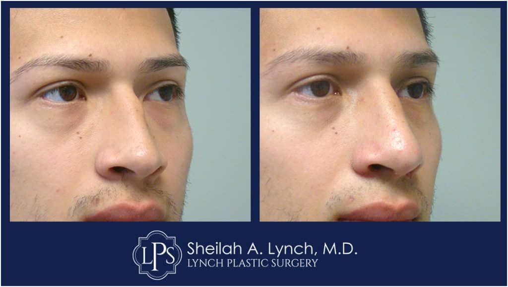 Rhinoplasty Patient 1 Photo Gallery, Sheilah Lynch MD