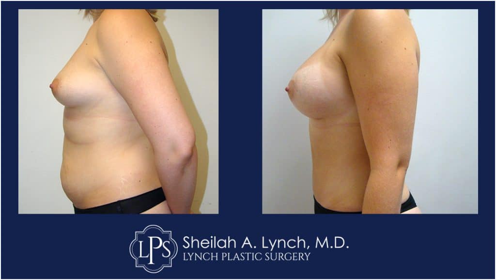 Before and after Breast Augmentation images, mommy makeover, easton maryland