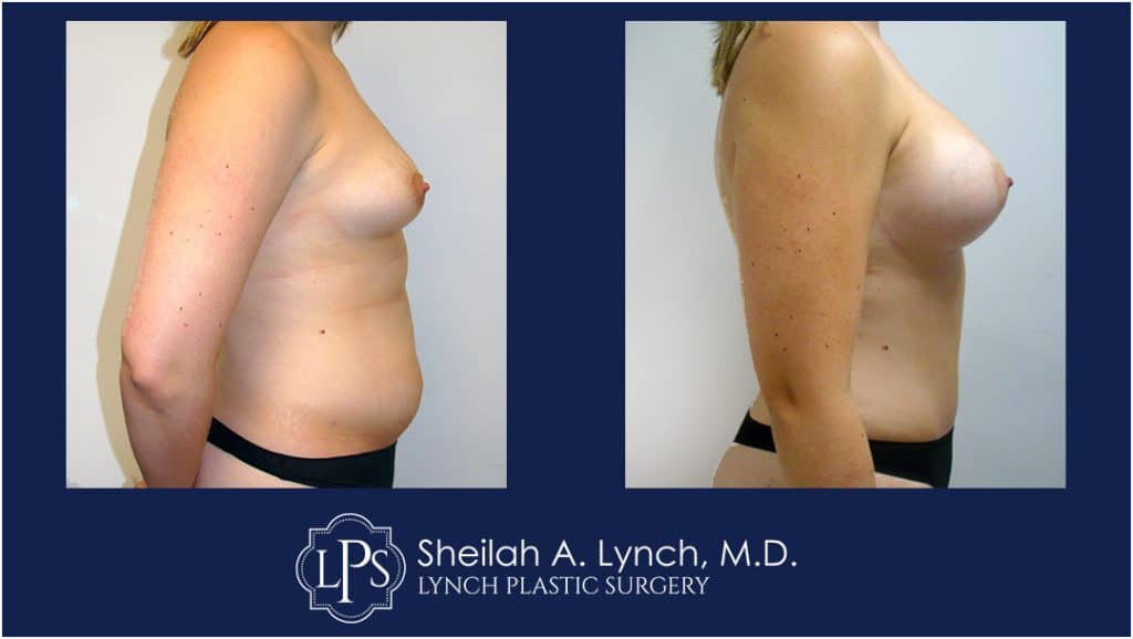 Mommy Makeover before and after photos - maryland - lynch plastic surgery -easton maryland