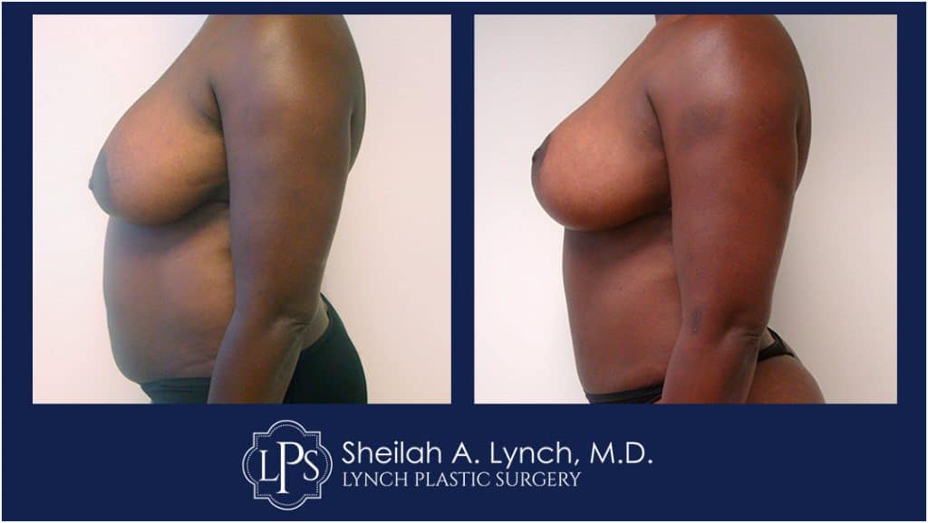 Before and after Breast Lift images, mommy makeover, easton maryland