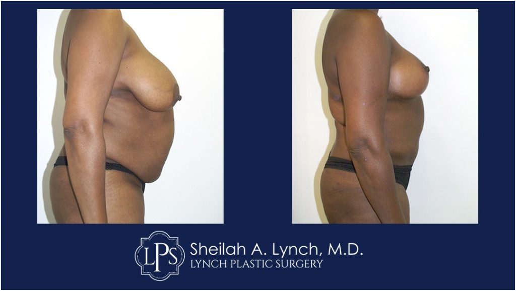 Before and after Breast Lift images, mommy makeover, easton maryland