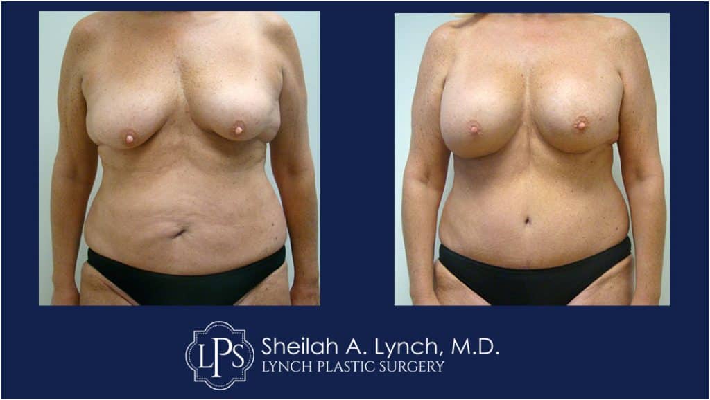 Before and after Breast Augmentation images, mommy makeover, easton maryland