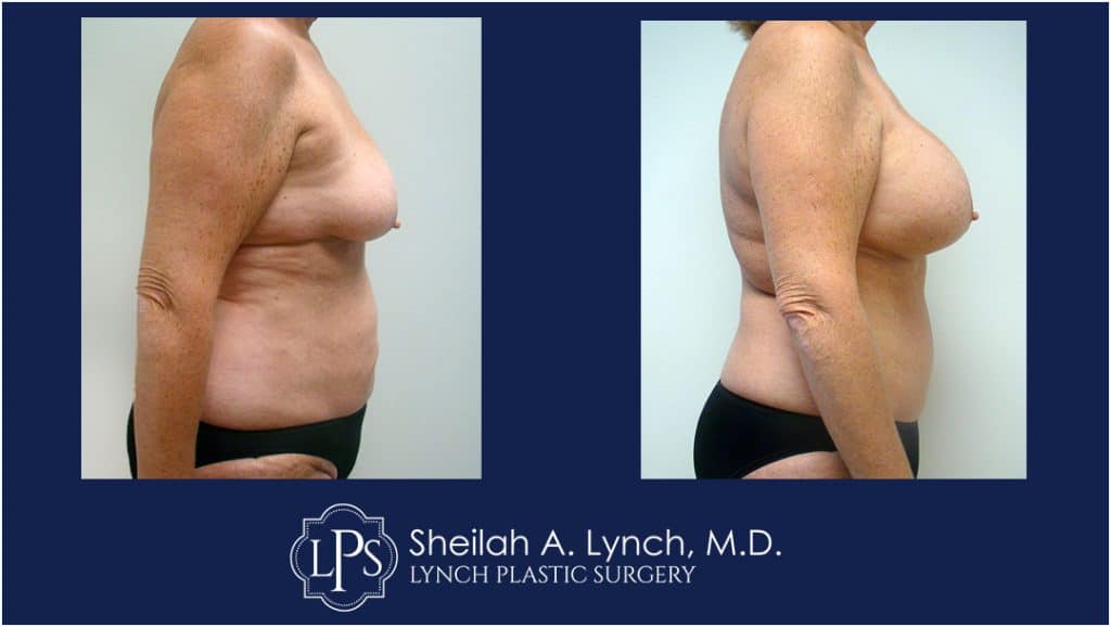 Before and after Breast Augmentation images, mommy makeover, easton maryland