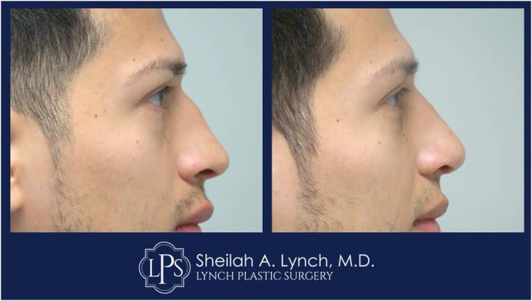 Rhinoplasty Patient 1 Nose Surgery Before & After Pictures - Rhinoplasty Surgeon Maryland