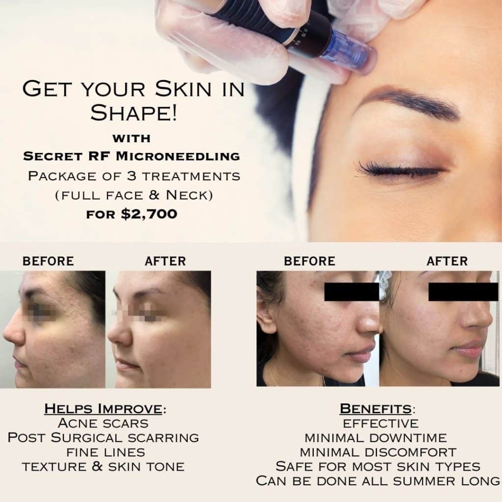 Save $300 On Microneedling Chevy Chase MD 3 Treatment Package.