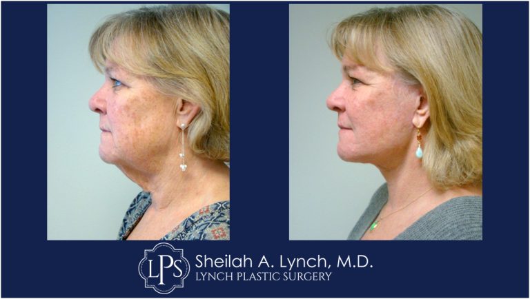 MACS Lift Neck Lift patient 5 Maryland Before After