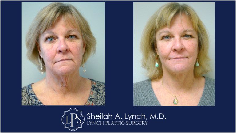 MACS Lift Neck Lift patient 5 Maryland Before After