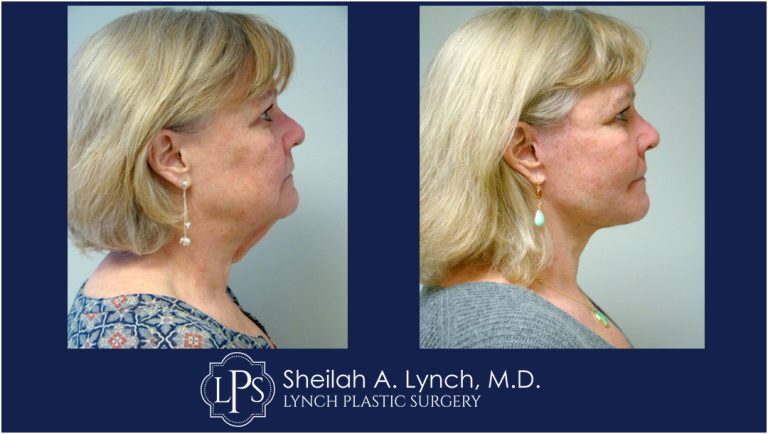 MACS Lift Neck Lift patient 5 Maryland Before After