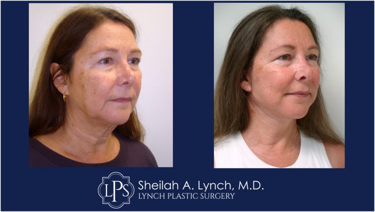MACS Lift before after patient 6 Maryland Before After