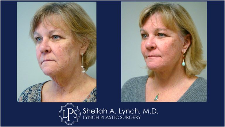 MACS Lift Neck Lift patient 5 Maryland Before After