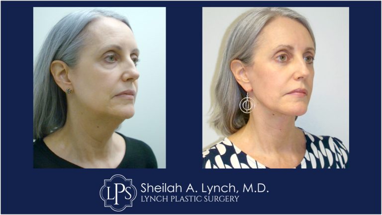 Neck Lift MACS lift before after patient 4 female - Lynch Plastic Surgery
