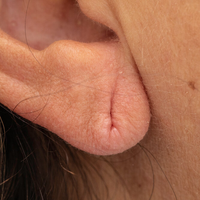 Earlobe Repair- Chevy Chase Maryland