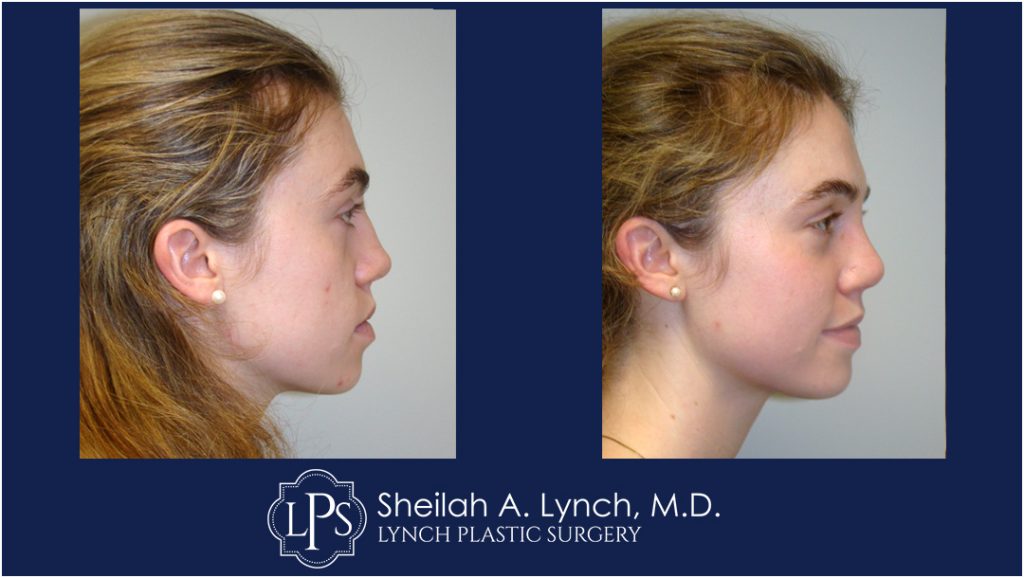Rhinoplasty patient 6 Nose Reshaping Before After Chevy Chase Maryland Plastic Surgeon Easton Maryland