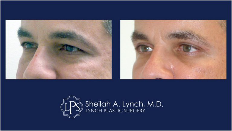 eyelid lift before after patient 11 easton maryland
