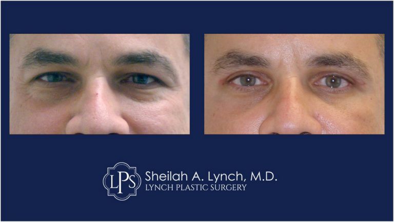 eyelid lift before after patient 11 easton maryland