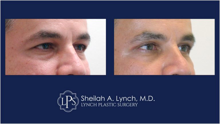eyelid lift before after patient 11 easton maryland