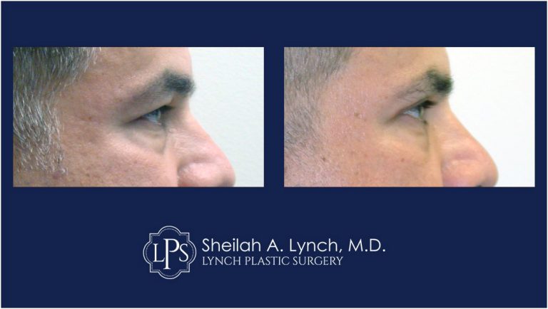 eyelid lift before after patient 11 easton maryland