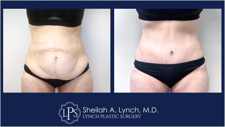 Excess Skin Removal After Weight Loss Patient 16 After Weight Loss Plastic Surgery Before And After Tummy Tuck With Liposuction
