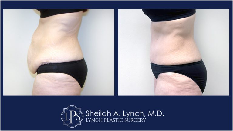 After Ozempic Weight Loss Before and After Image Plastic Surgery Before And After Tummy Tuck With Liposuction