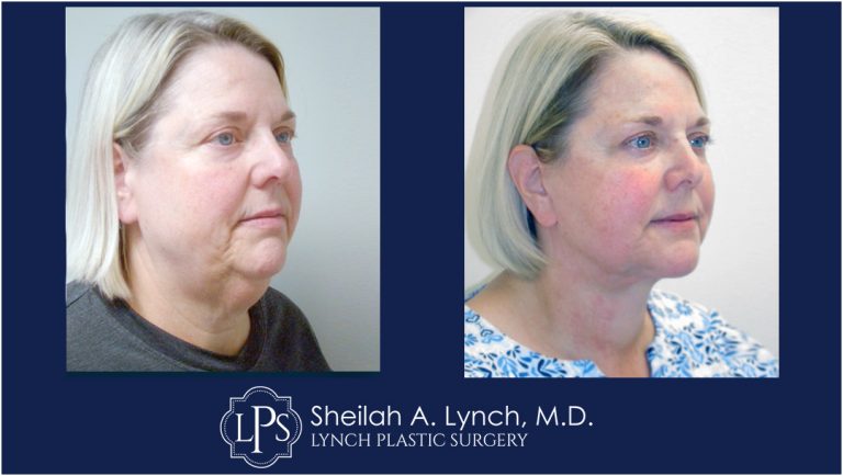 Neck Lift Patient 19 Easton Maryland Before and After Images