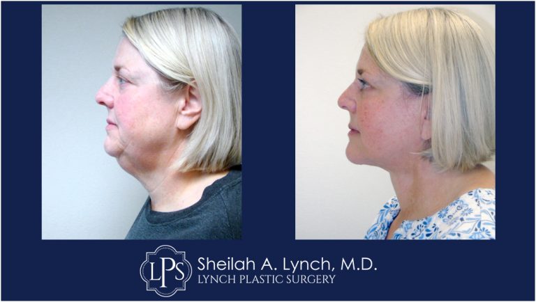 Neck Lift Patient 19 Easton Maryland Before and After Images