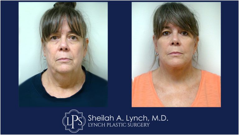 Neck Lift Patient 9 Before and After Images Maryland