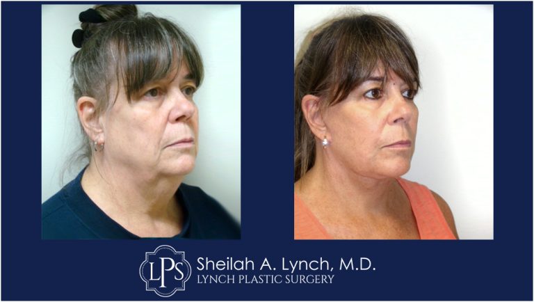 Neck Lift Patient 9 Before and After Images Maryland