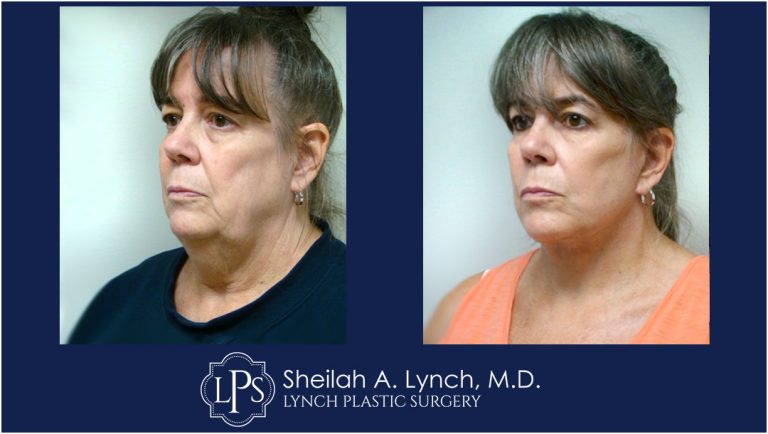 Neck Lift Patient 9 Before and After Images Maryland