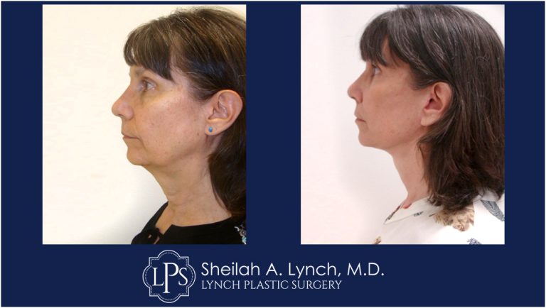Neck Lift Patient 12 Before And After Images Neck Lift Surgeon Maryland