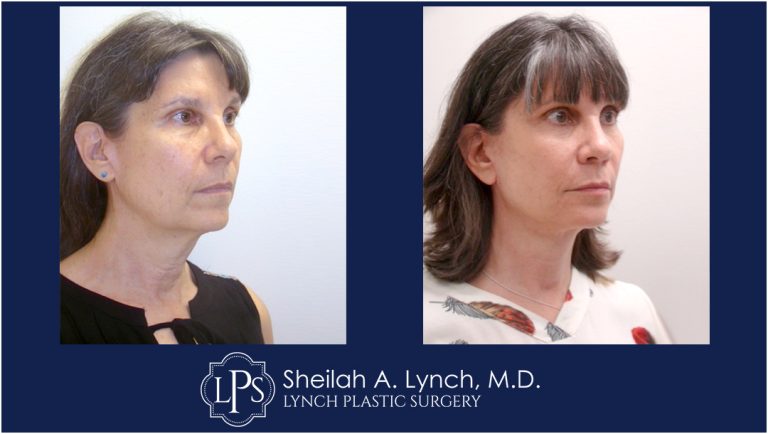 Neck Lift Patient 12 Before And After Images Neck Lift Surgeon Maryland