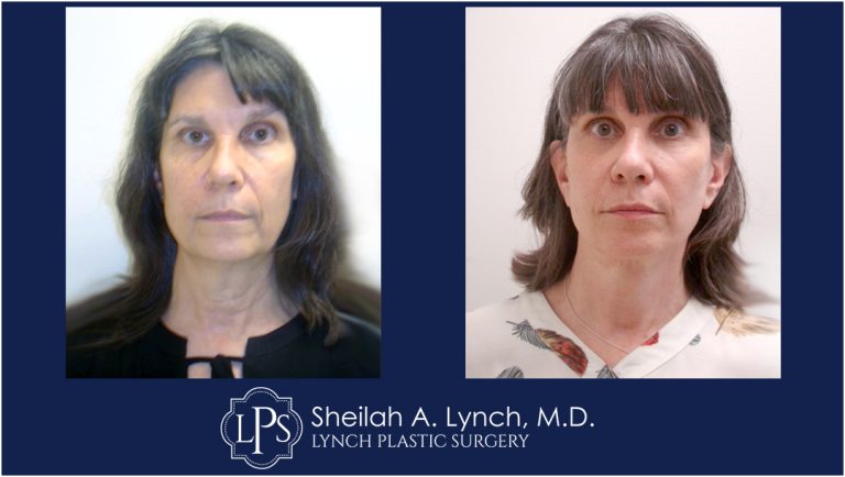 Neck Lift Patient 12 Before And After Images Neck Lift Surgeon Maryland