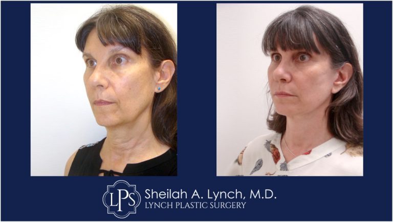 Neck Lift Patient 12 Before And After Images Neck Lift Surgeon Maryland
