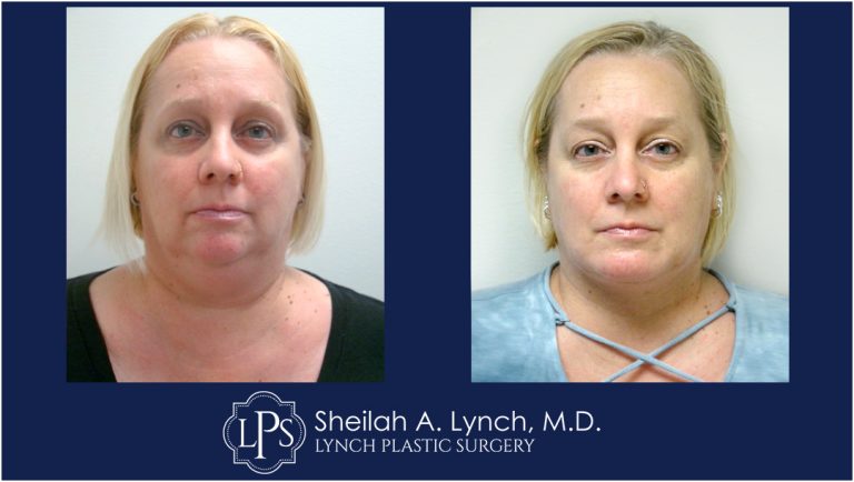 Neck Lift Patient 9 Before and After Images Maryland