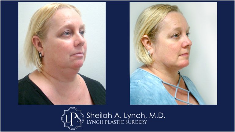 Neck Lift Patient 9 Before and After Images Maryland
